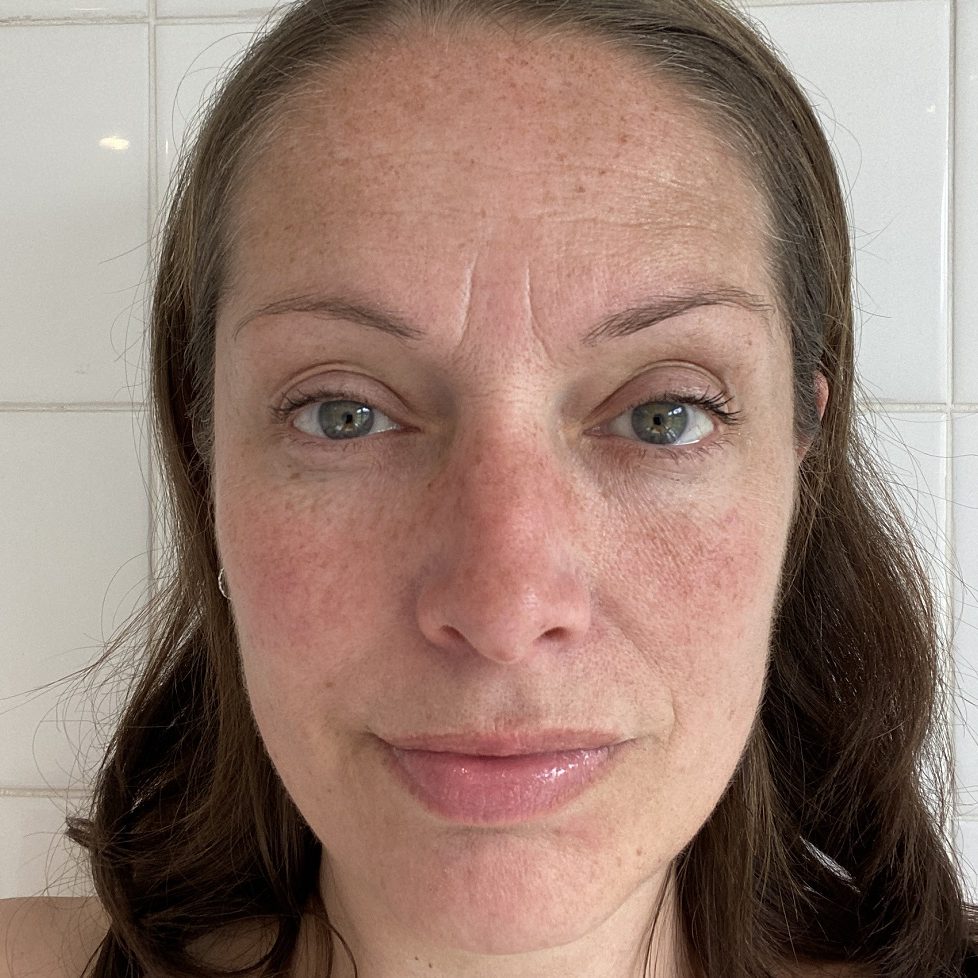 woman with melasma hyperpigment pigment markings on face